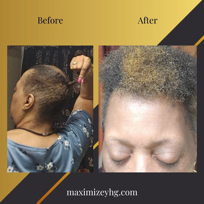 Beat Alopecia Bundle