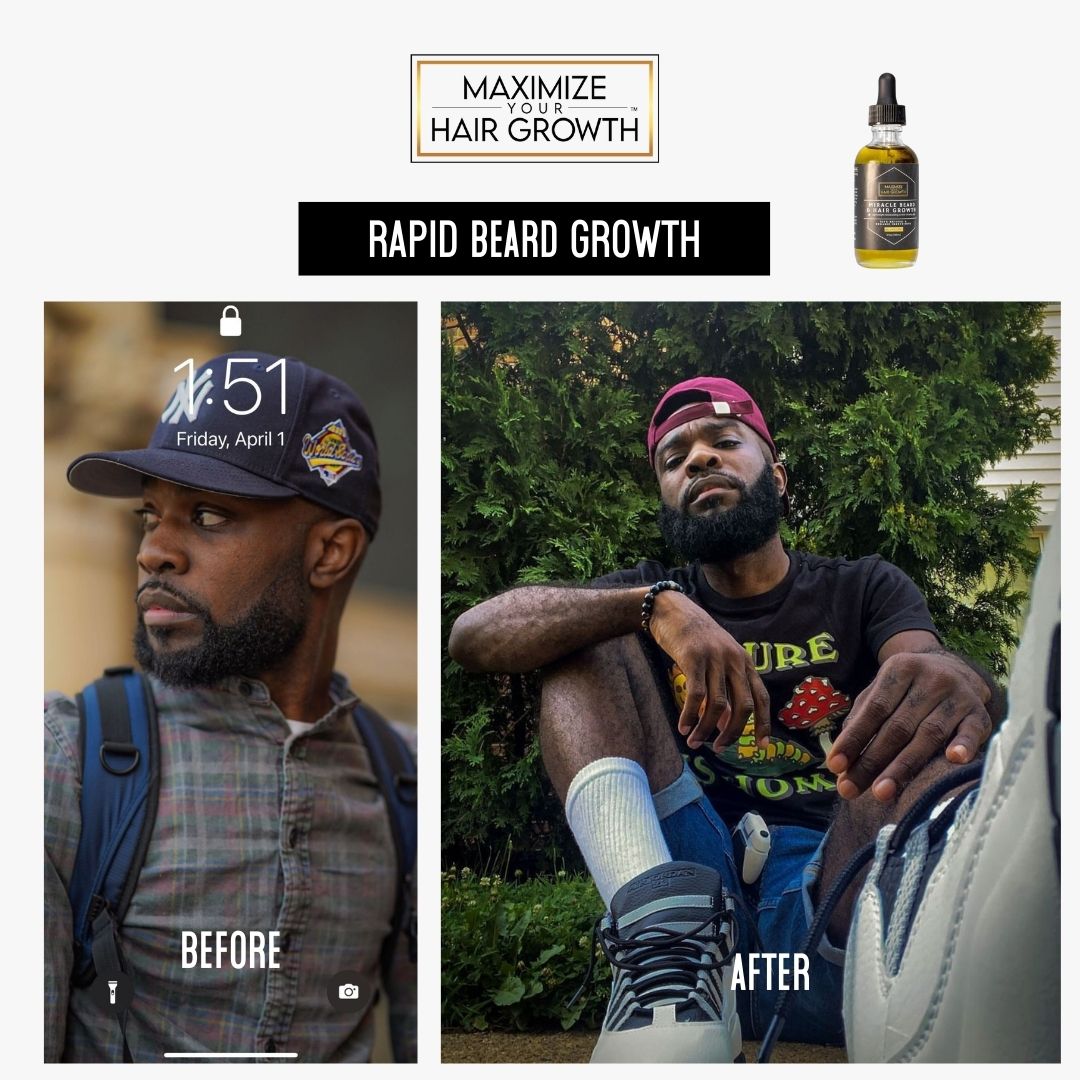 Miracle Beard & Hair Growth Oil for MEN